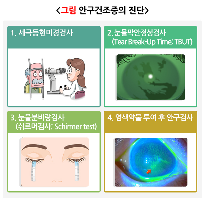 안구건조증-치료방법